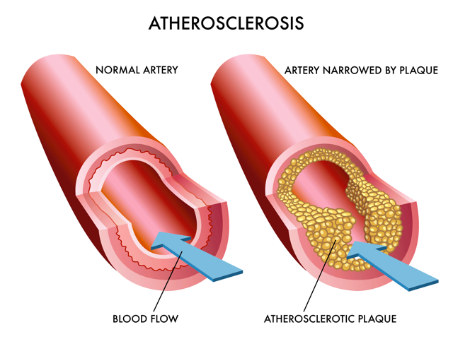 cholesterol